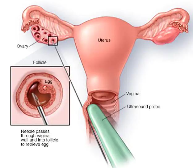Before Egg Freezing